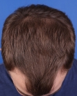 Before Hair Transplant&nbsp;Hairlines